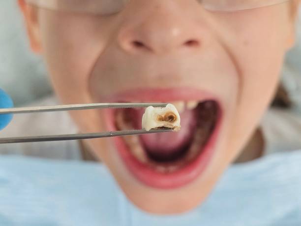 Best Emergency Dentist for Lost Fillings or Crowns in Westhaven Moonstone, CA